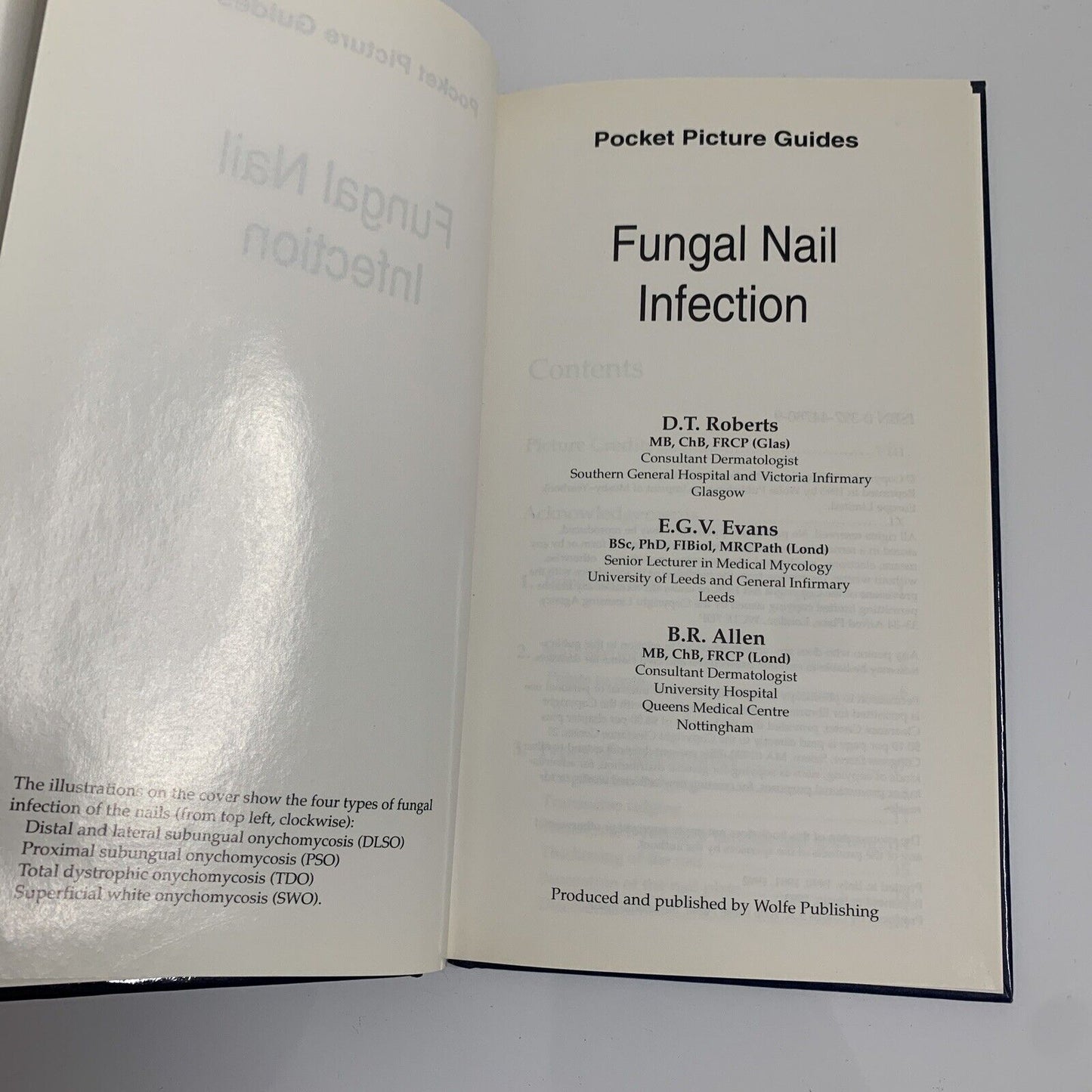 Fungal Nail Infection Pocket Picture Guide by D T Roberts, E G V Evans, B Allen